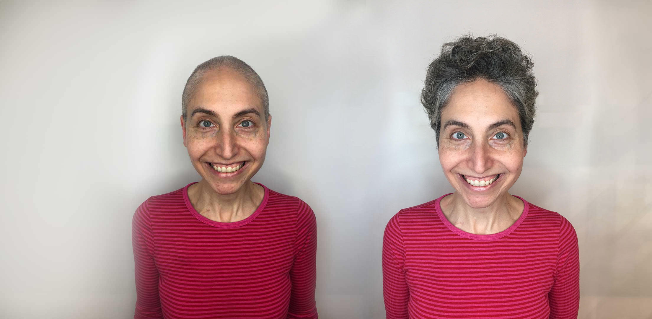 Left: Garam after getting her head shaved at the hair salon, November 2018.
Right: After completing treatment with a full head of hair, December 2019. 